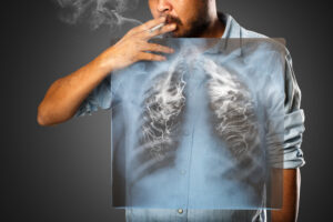 Read more about the article Does Smoking Weed Cause Lung Cancer