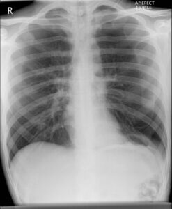 Read more about the article The Effects of Long-Term Marijuana Use on Lung Health: A Five-Year Perspective